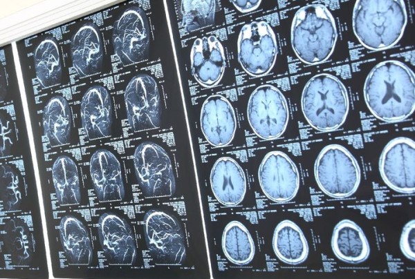 MRIとMRAで脳を診断
